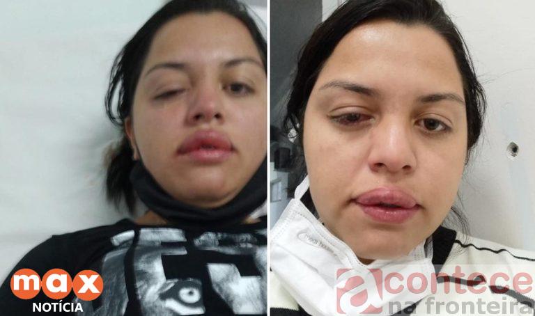 Faxineira atacada pelo ex-patrão com ácido teme perder visão de um olho: ‘Não consigo enxergar’