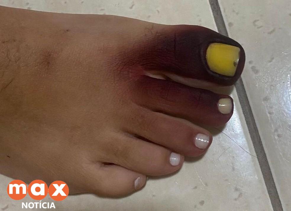 Carioca fica com pé roxo e unha amarela ao calçar tênis com piolho-de-cobra