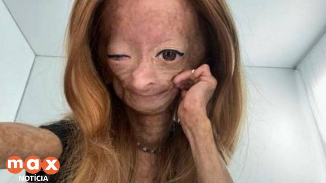 Aos 15 anos morre Adalia Rose, que sofria de doença que causava ‘velhice precoce’